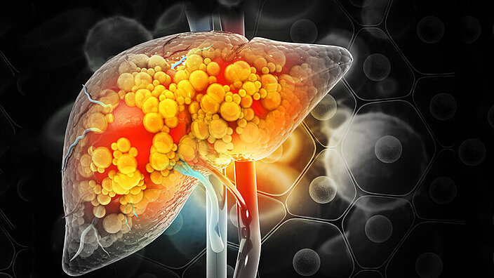 Liver damage such as Fatty liver, Fibrosis, Cirrhosis, and Liver cancer. 3d illustration