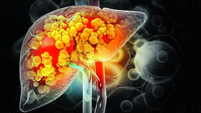 Liver damage such as Fatty liver, Fibrosis, Cirrhosis, and Liver cancer. 3d illustration